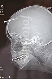 headache.jpg